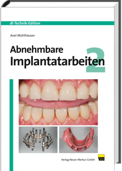 Abnehmbare Implantatarbeiten 2