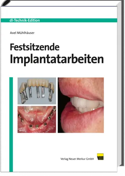 Festsitzende Implantatarbeiten